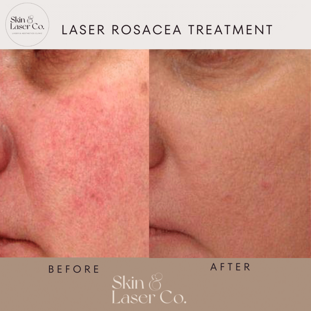 Laser Treatment for Rosacea Skin Laser Co