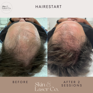 Fotona’s HaiRestart® hair growth stimulation is an effective method of treating hair loss disorders. This innovative solution is focused on stimulating dormant hair follicles to promote hair growth. Before and After