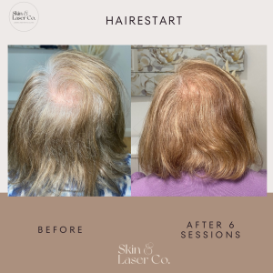 Fotona's HaiRestart hair growth stimulation Before & After