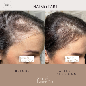 Fotona’s HaiRestart® hair growth stimulation is an effective method of treating hair loss disorders. This innovative solution is focused on stimulating dormant hair follicles to promote hair growth. Before and After