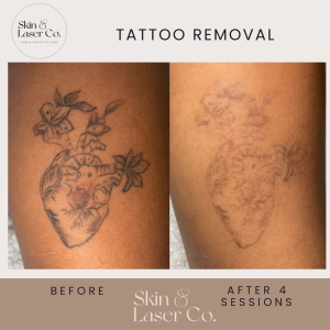 Laser tattoo removal before and after treatment at Skin & Laser Co.