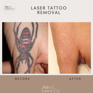 Laser tattoo removal before and after treatment at Skin & Laser Co.