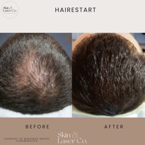 Fotona’s HaiRestart® hair growth stimulation is an effective method of treating hair loss disorders. This innovative solution is focused on stimulating dormant hair follicles to promote hair growth. Before and After